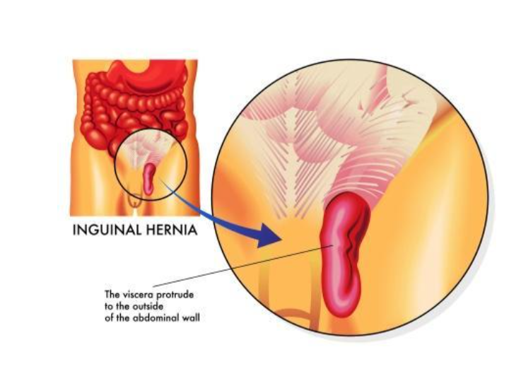 Best hospital for hernia surgery in Kurnool