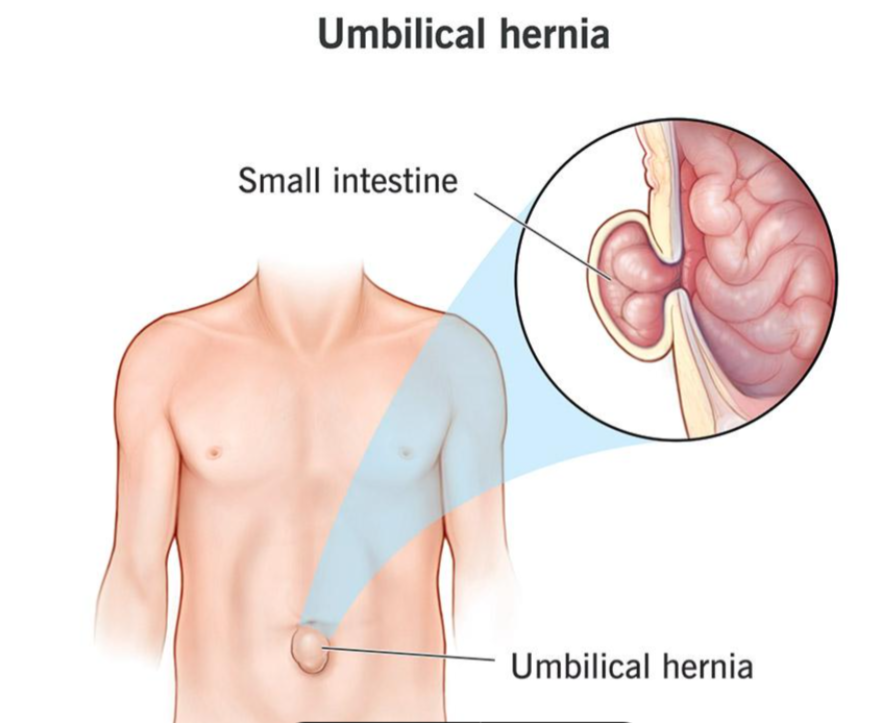 Hernia treatment
