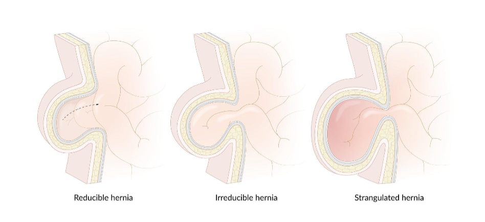 Best hospital for hernia surgery in Kurnool